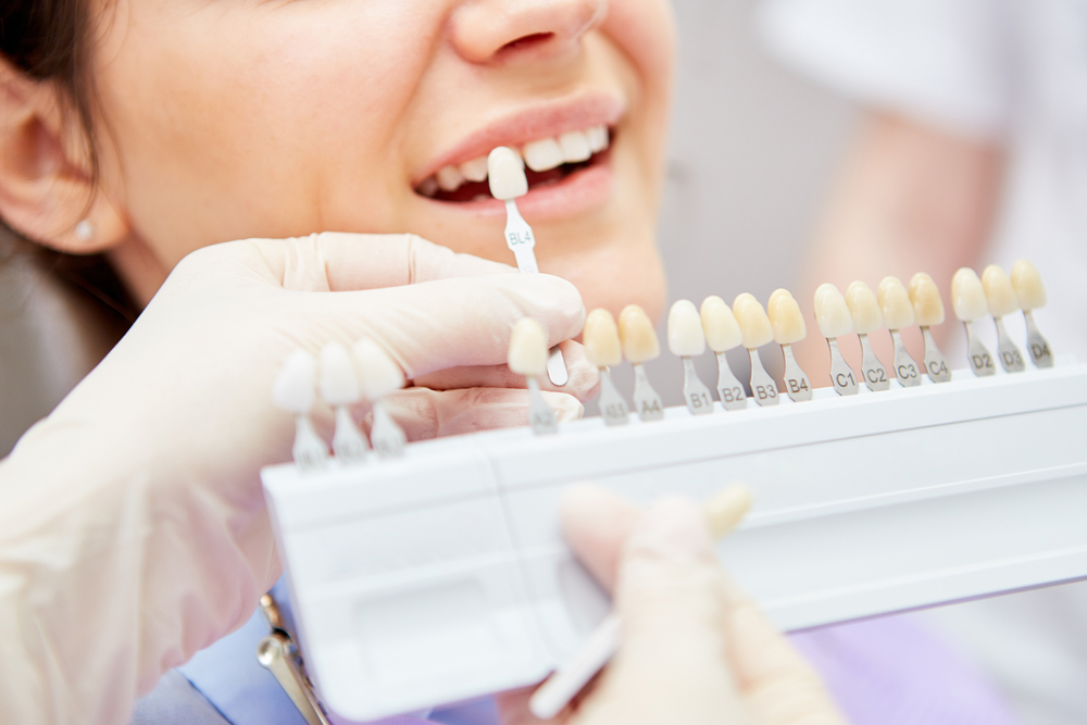 Selection,Of,The,Correct,Tooth,Color,For,Professional,Cosmetic,Bleaching