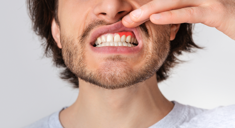 Gingival,Inflammation,And,Dental,Problems.,Guy,Suffering,From,Pain,,Pushes