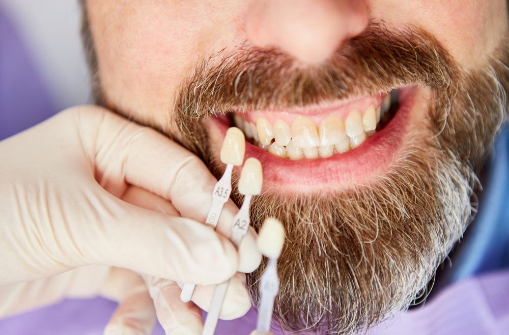 Adjustment,Of,The,Tooth,Color,Of,The,Patient,During,Professional