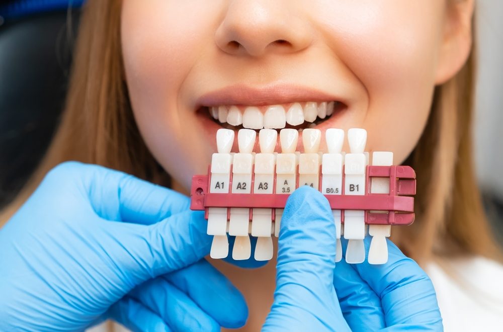 Set,Of,Implants,With,Various,Shades,Of,Tone,For,Whitening